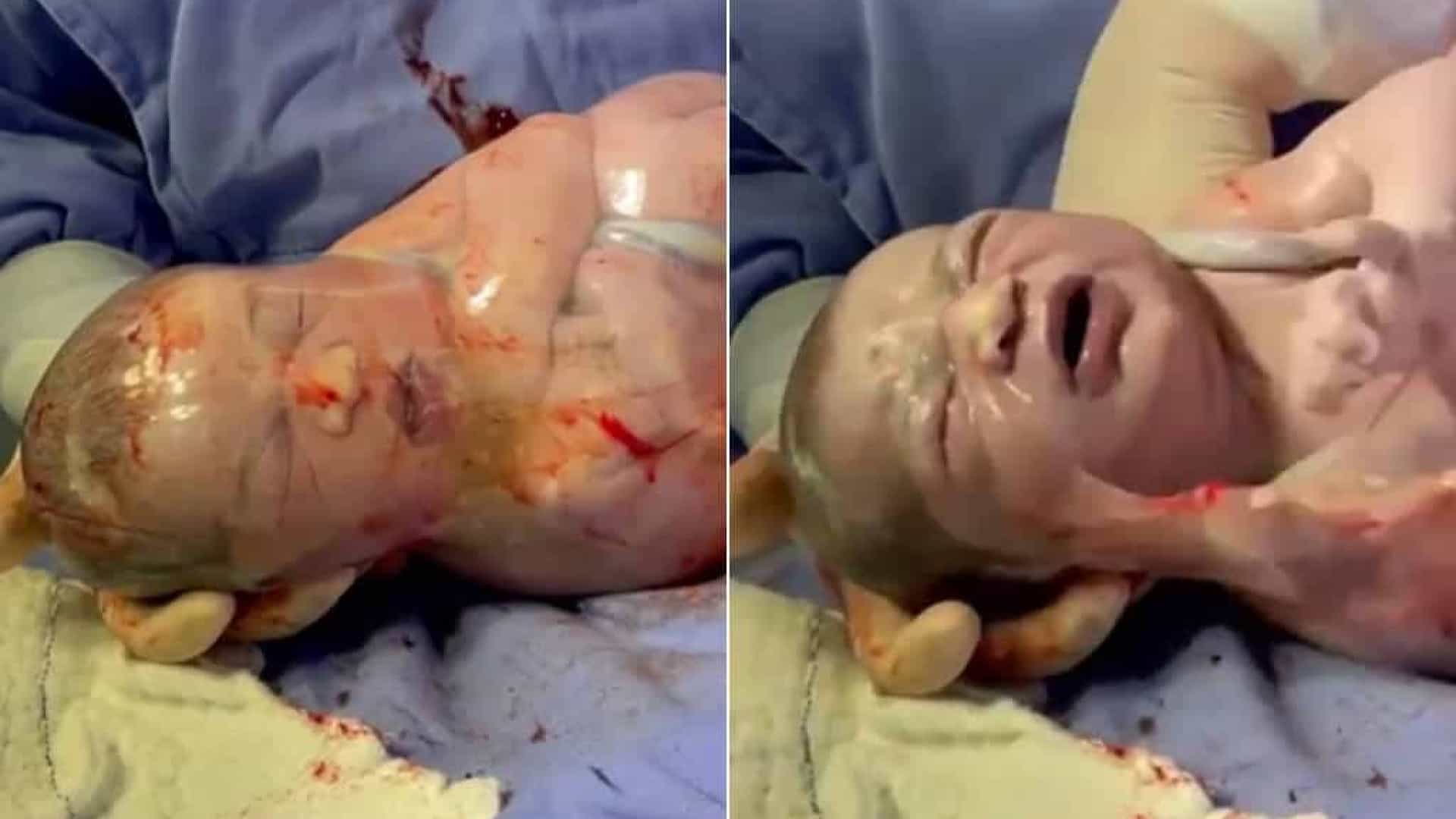 VEJA VÍDEO: Bebê nasce empelicado e vídeo e médico rompendo bolsa viraliza